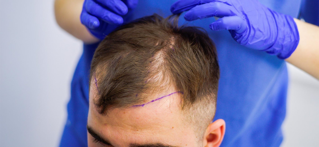 https://highness.site/wp-content/uploads/2023/12/HAIR-TRANSPLANT-2-1.png